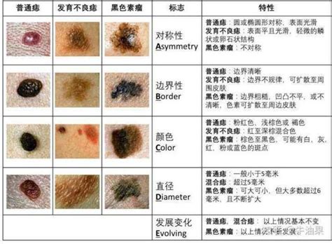 痣 凸起來|痣是什麼？會變成黑色素瘤？7種一定要除的痣